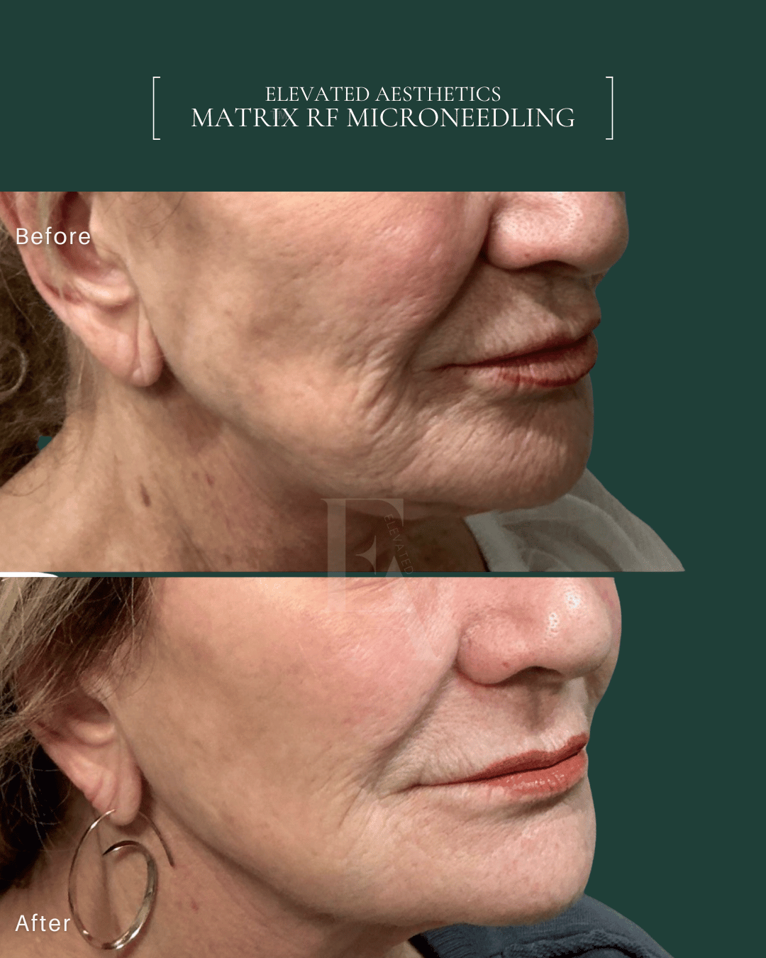 Elevated Aesthetics Matrix RF Microneedling