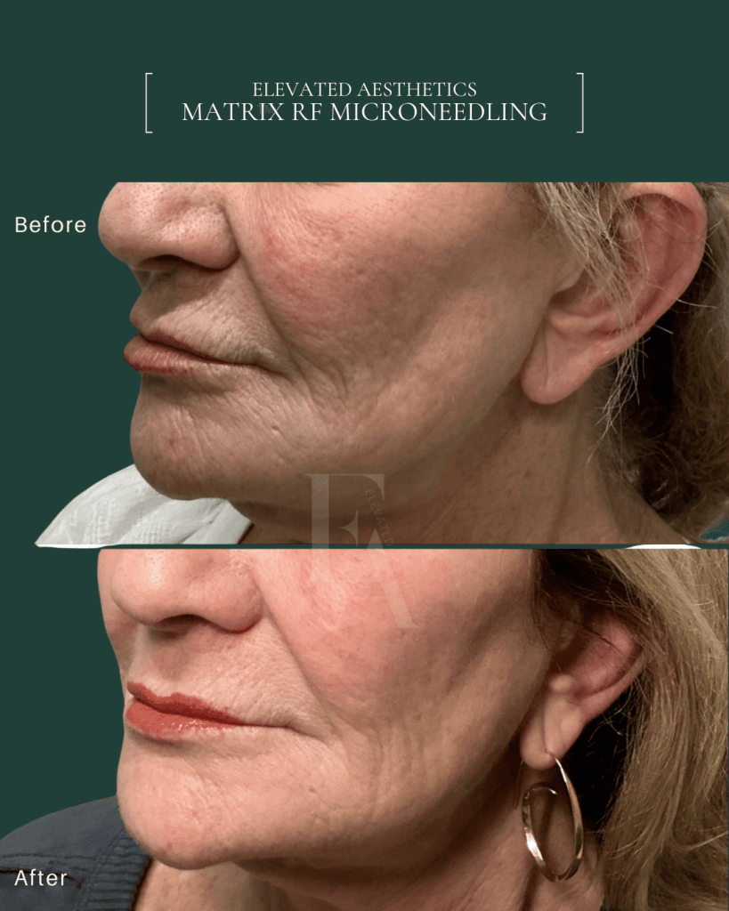 Elevated Aesthetics Matrix RF Microneedling